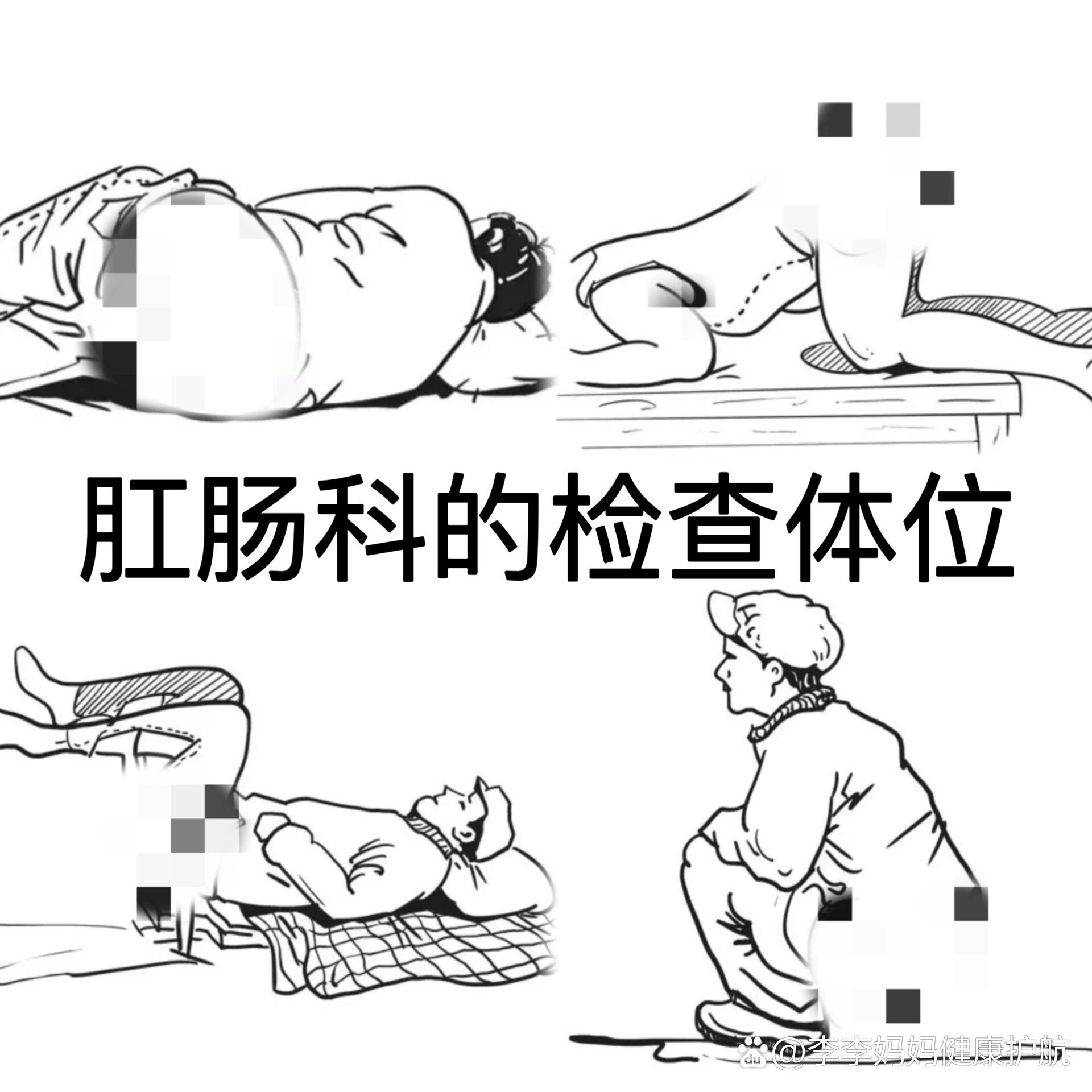 充分向前屈曲,靠近腹部,使臀部及 充分暴露,是常用的检查与治疗的体位