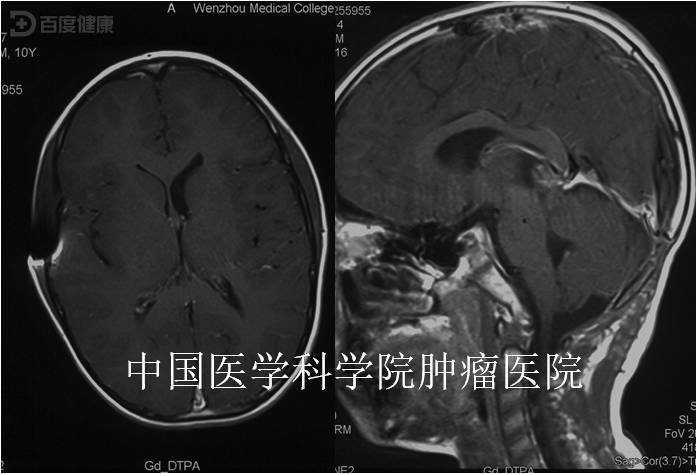 松果体区畸胎瘤图片