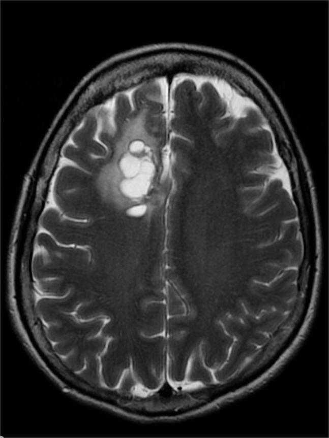 神经节细胞瘤,手术治疗是关键