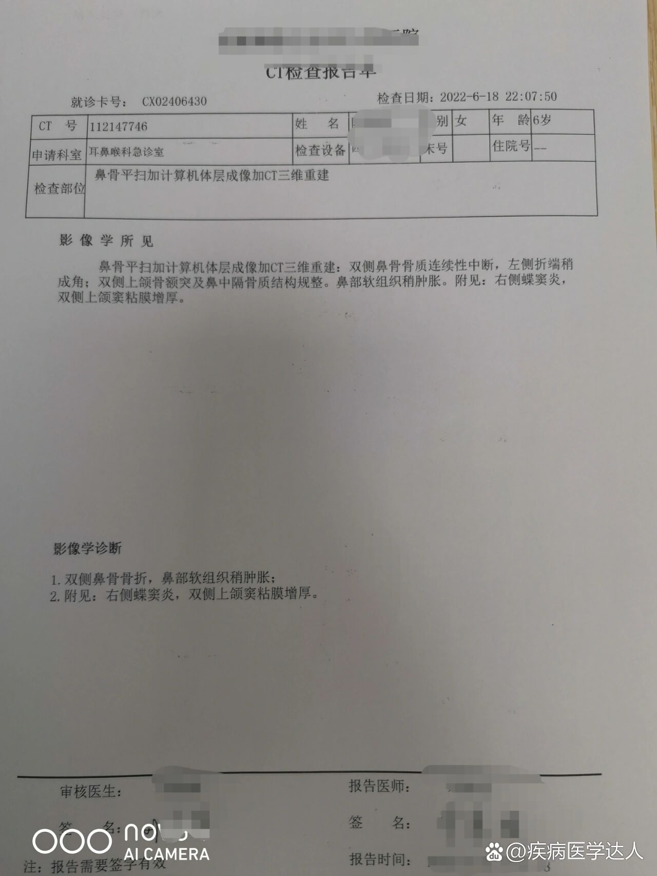  p>鼻骨骨折复位 br>6岁小朋友在和同伴玩耍时被撞,后ct检查说双侧鼻