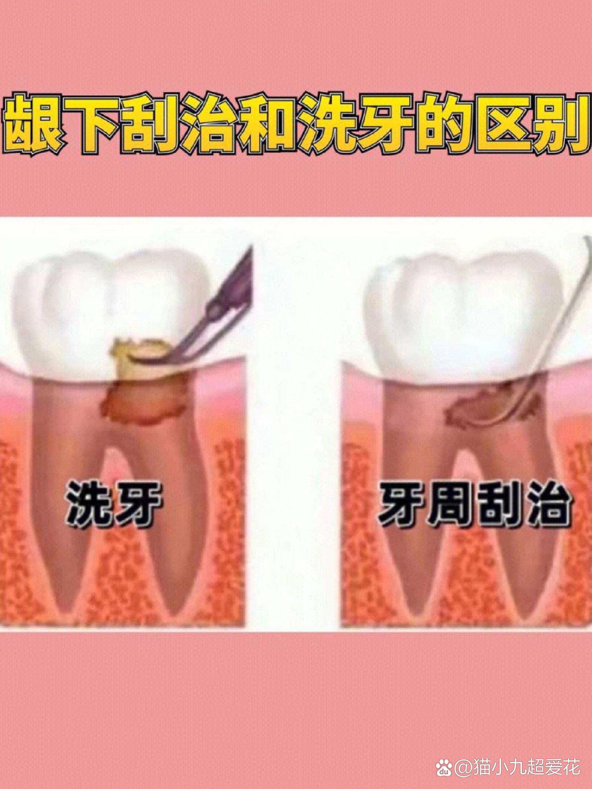 刮治器怎么区分图解图片