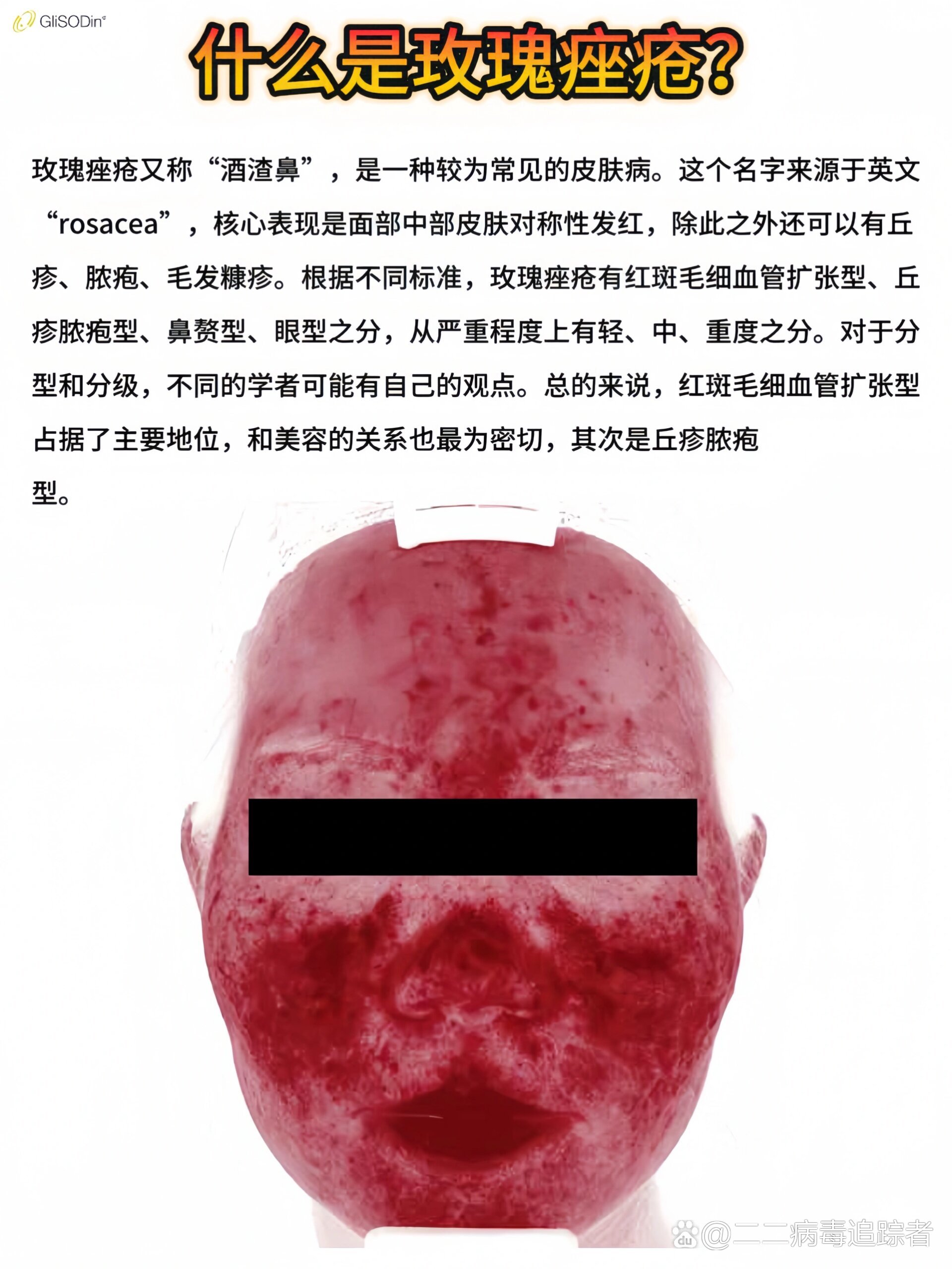 玫瑰痤疮治疗攻略