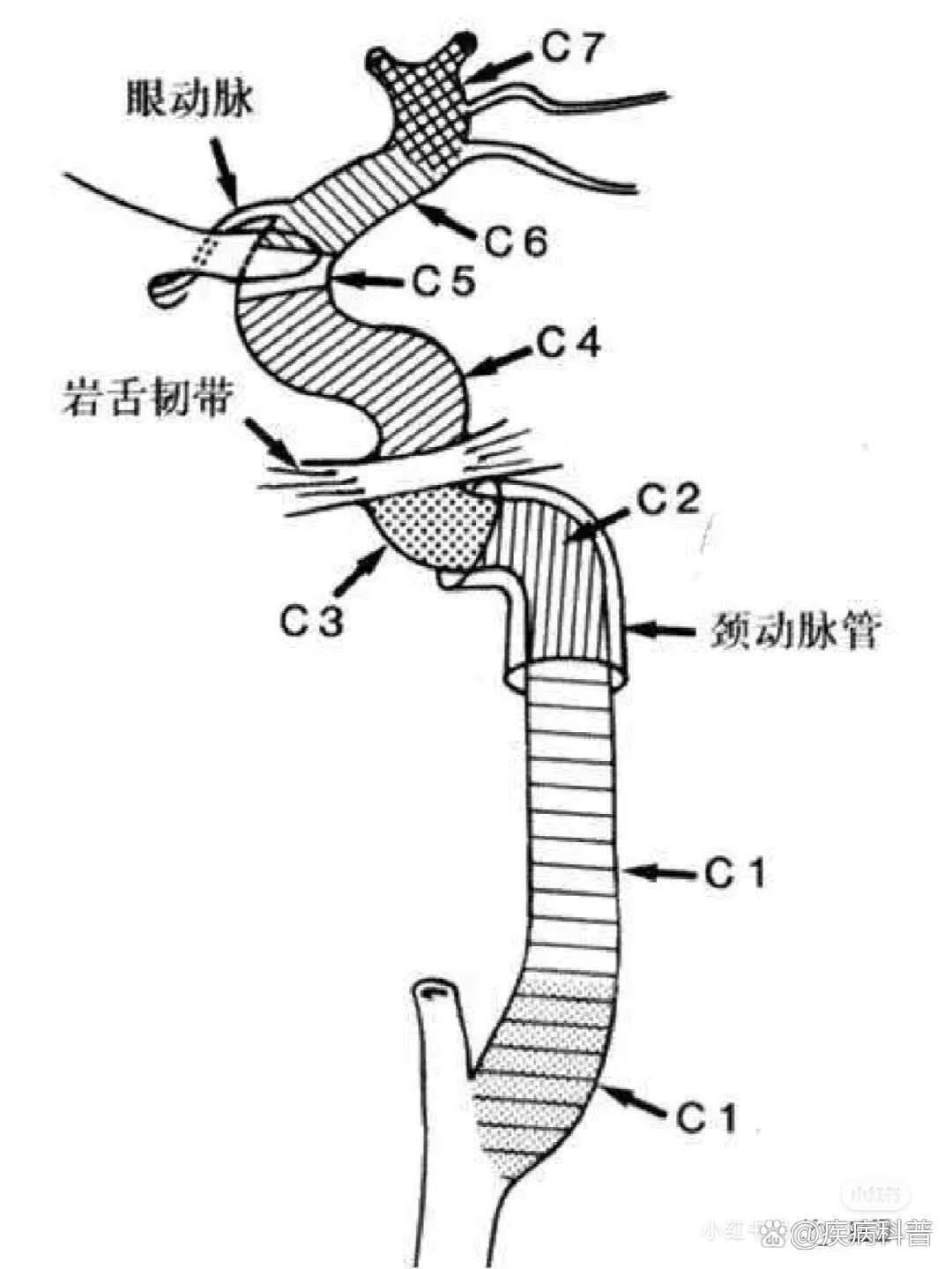 颈内动脉分段ct图示