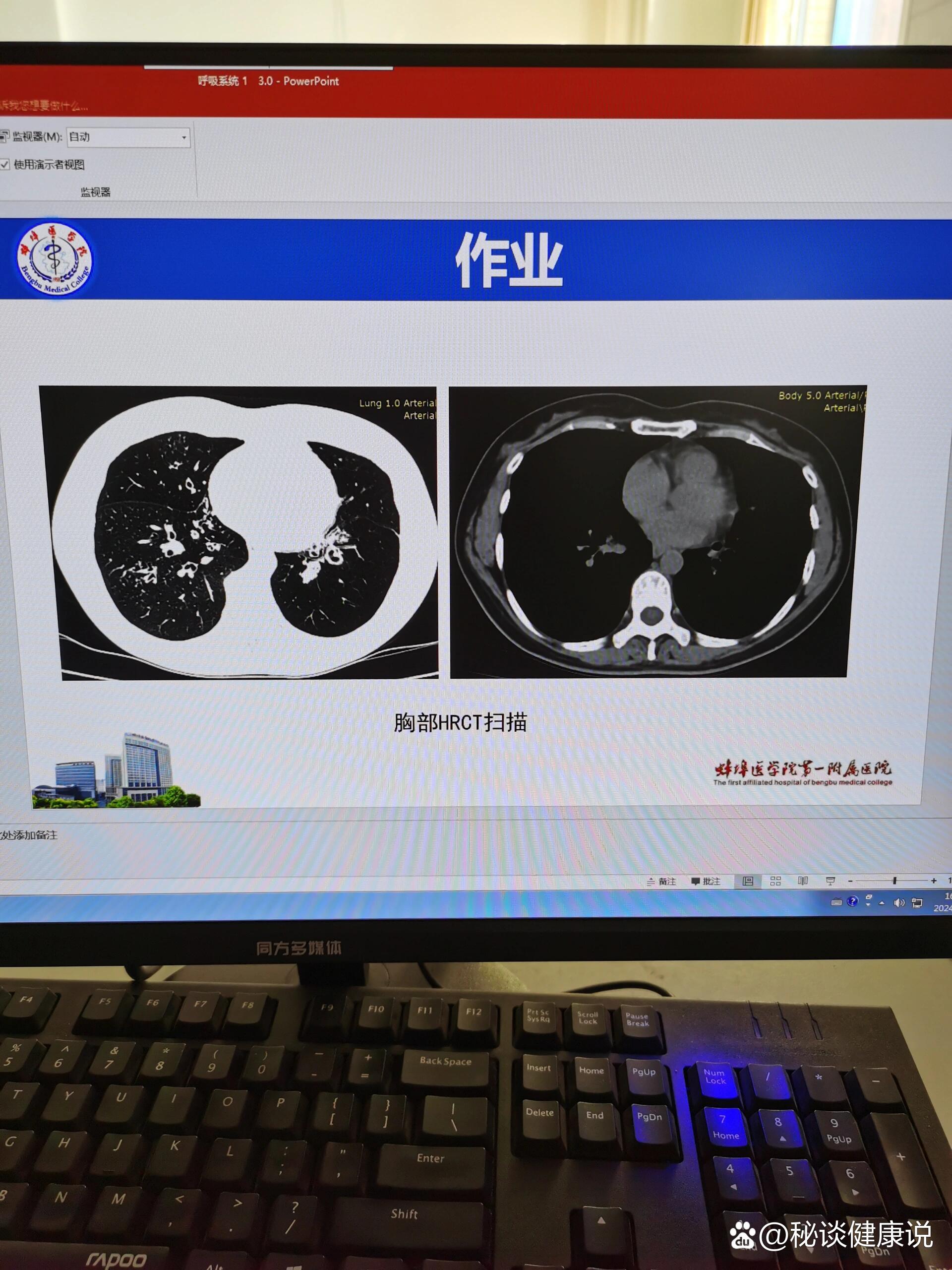 支气管扩张x光图片