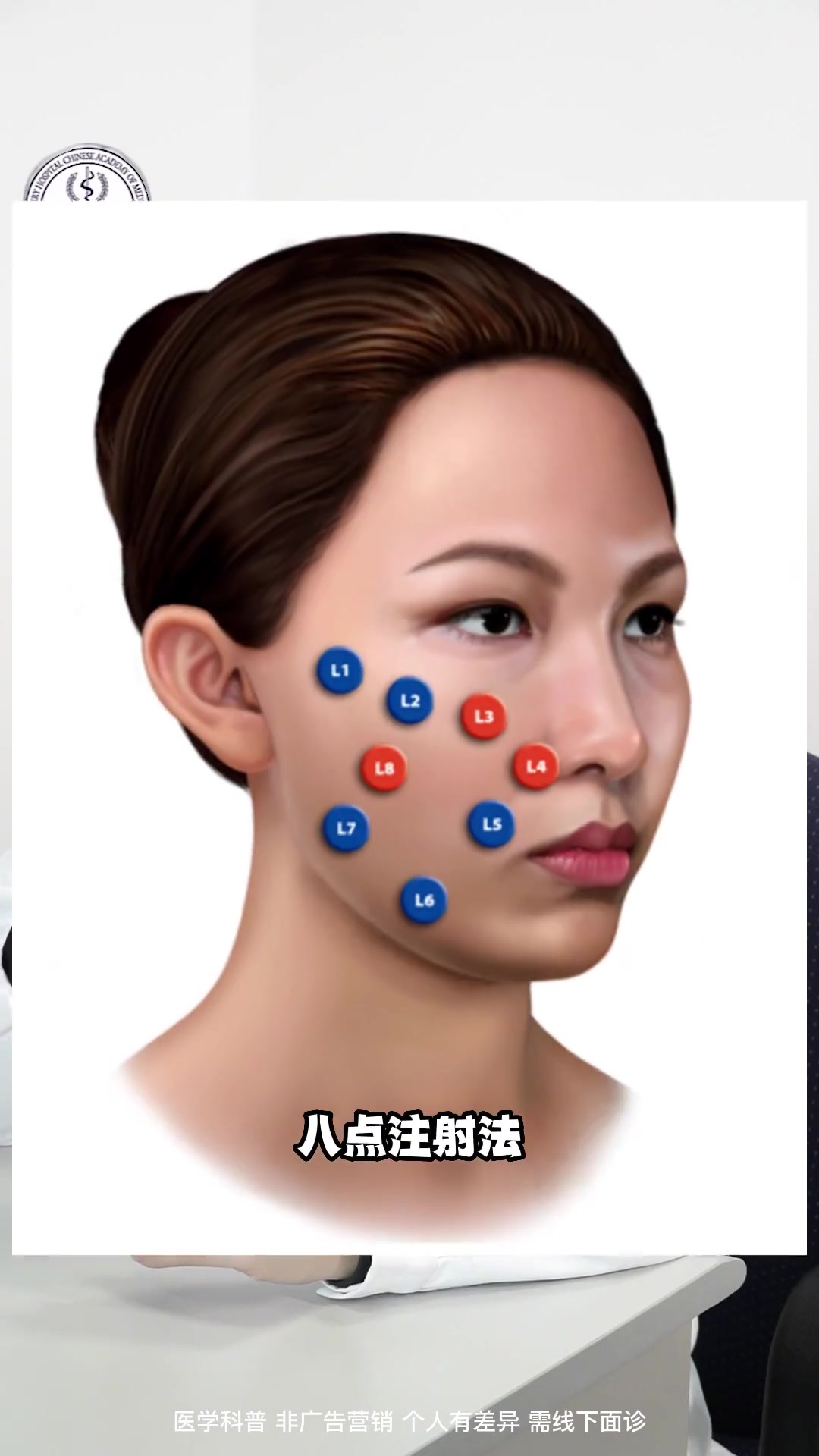 轮廓针注射点位