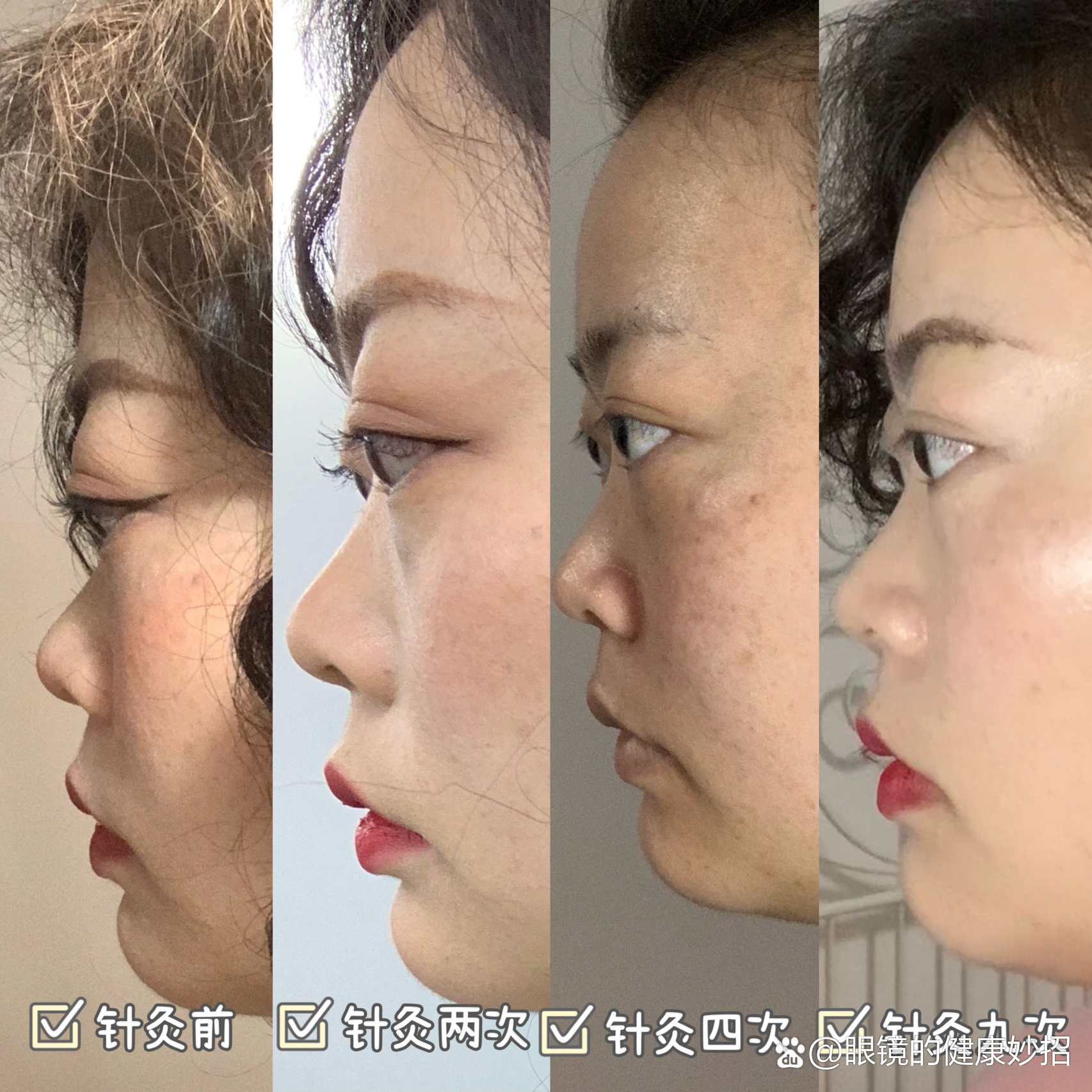 治疗甲亢眼突