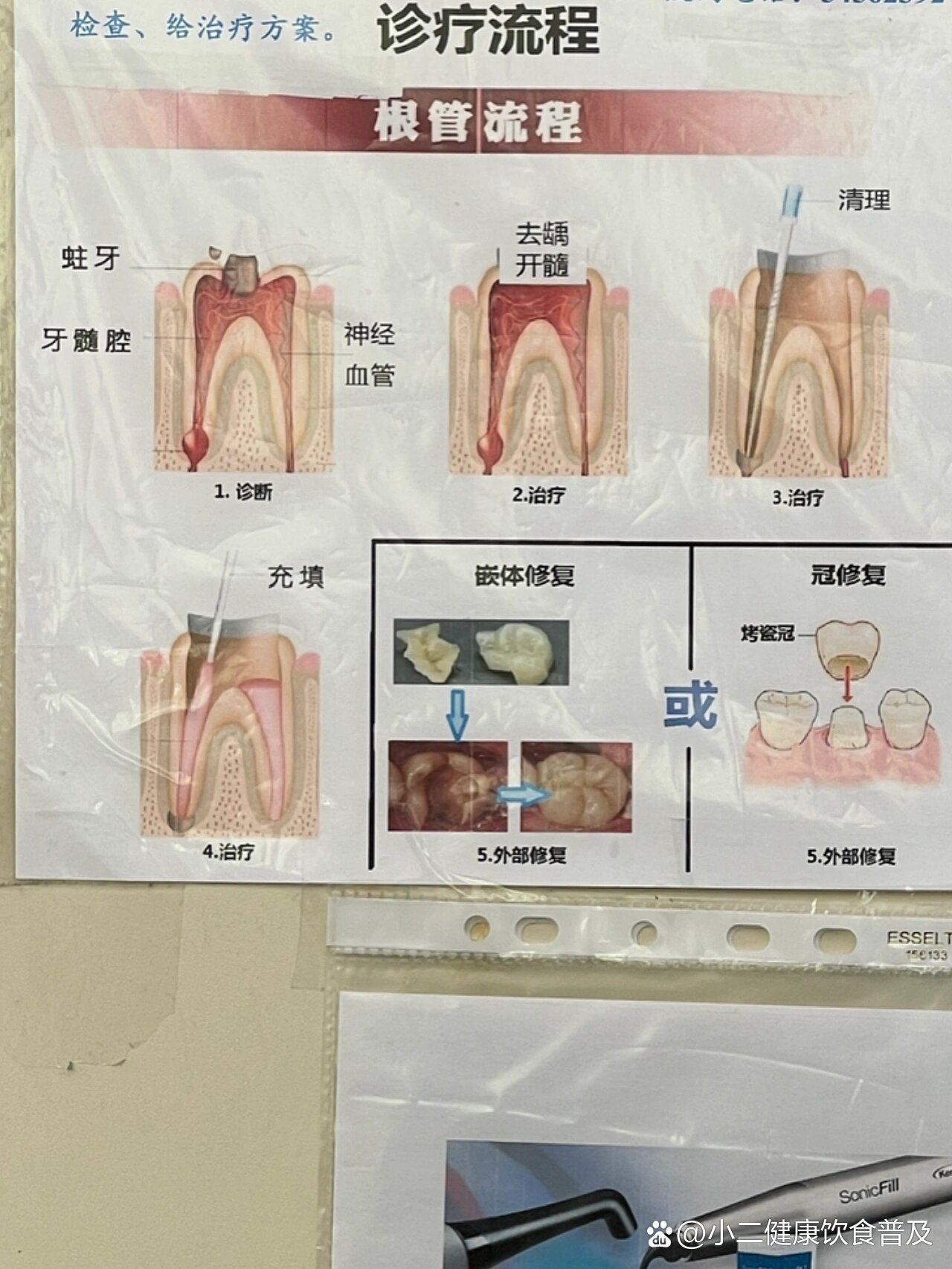 牙齿根管治疗步骤图图片