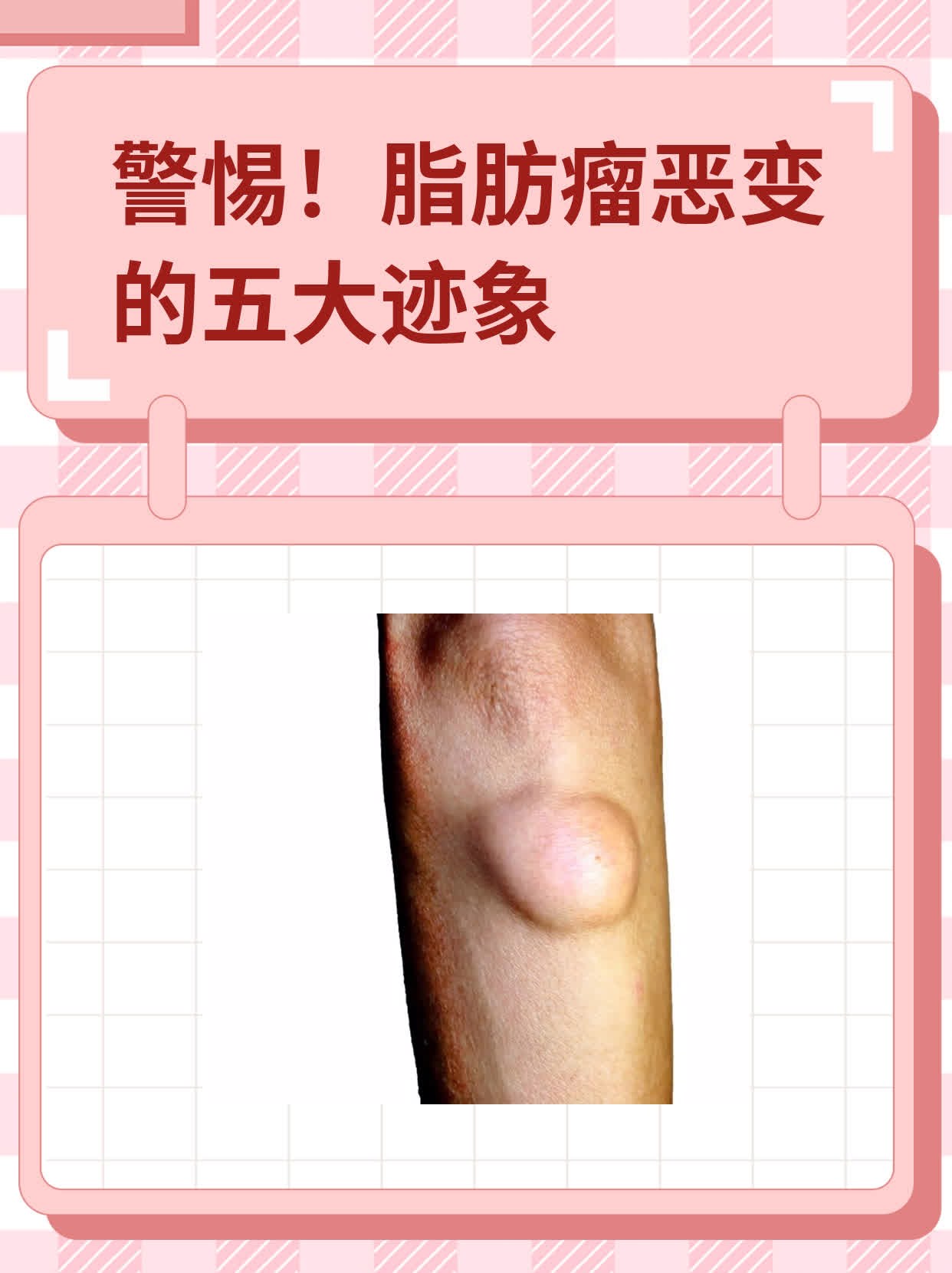 警惕!脂肪瘤恶变的五大迹象