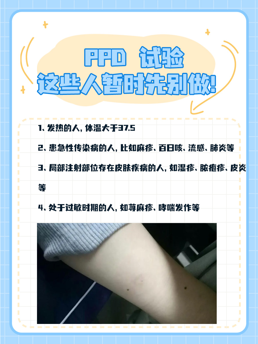 ppd试验:掌握这些,轻松判断结果