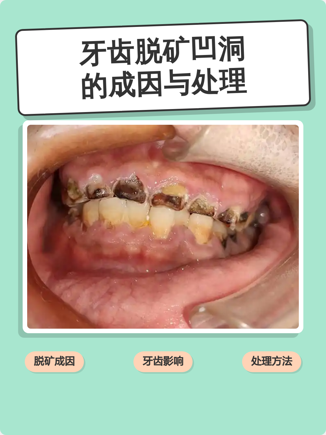 牙齿脱矿凹洞的成因与处理