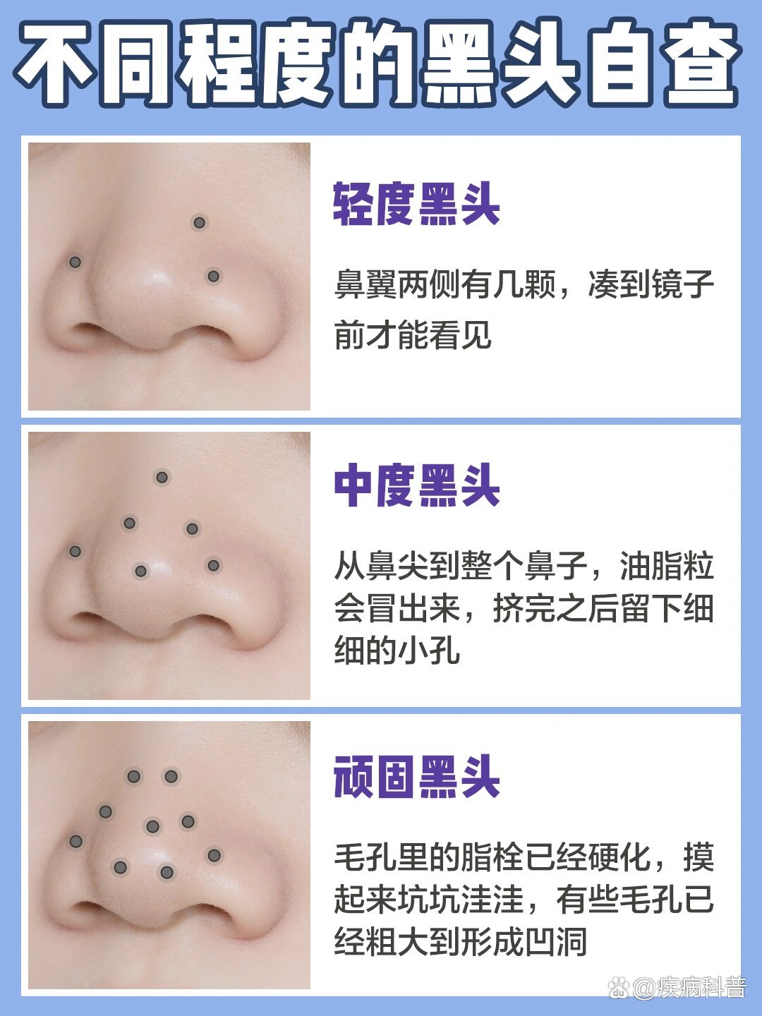 p 保姆级的去黑头攻略 草莓鼻逆袭成功