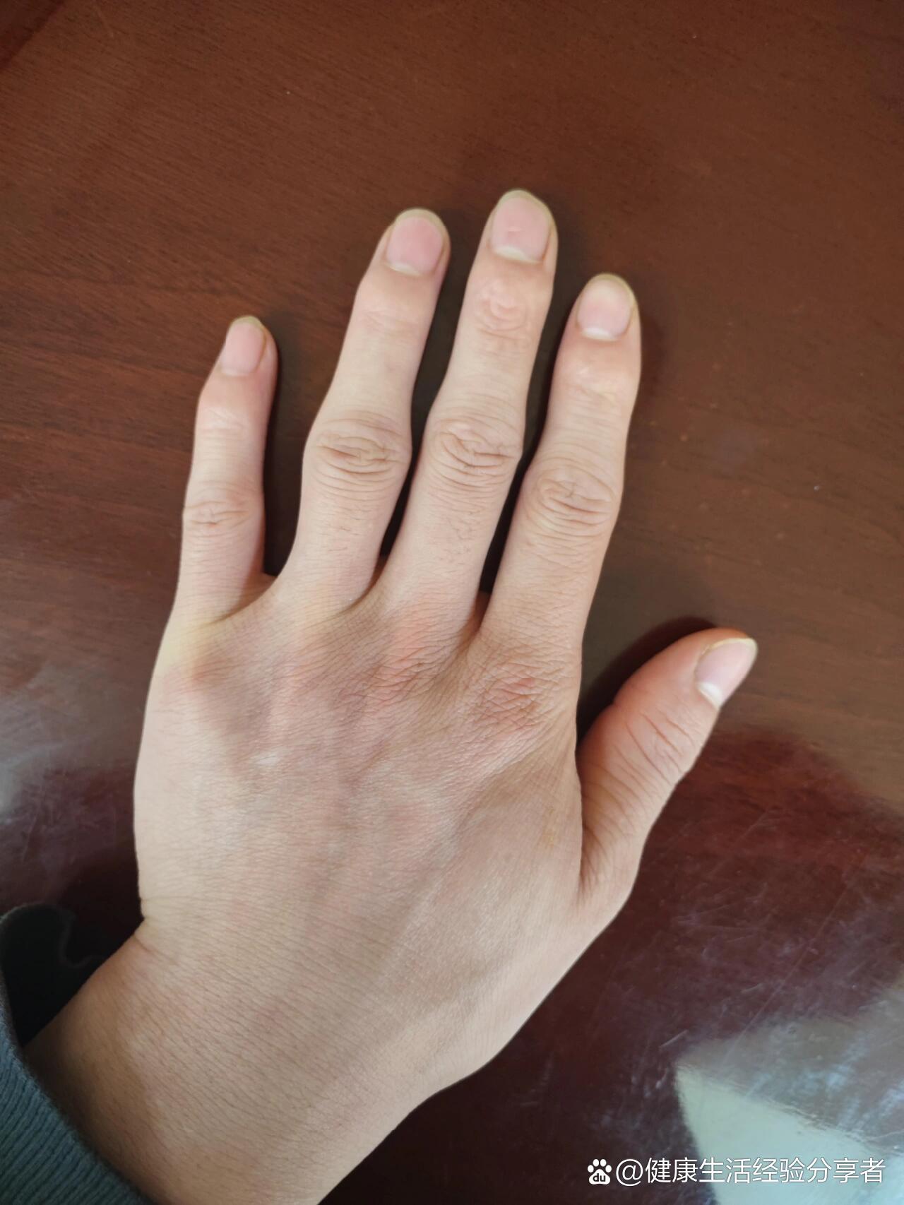 21岁得了关节炎,类风湿,看看你们的手