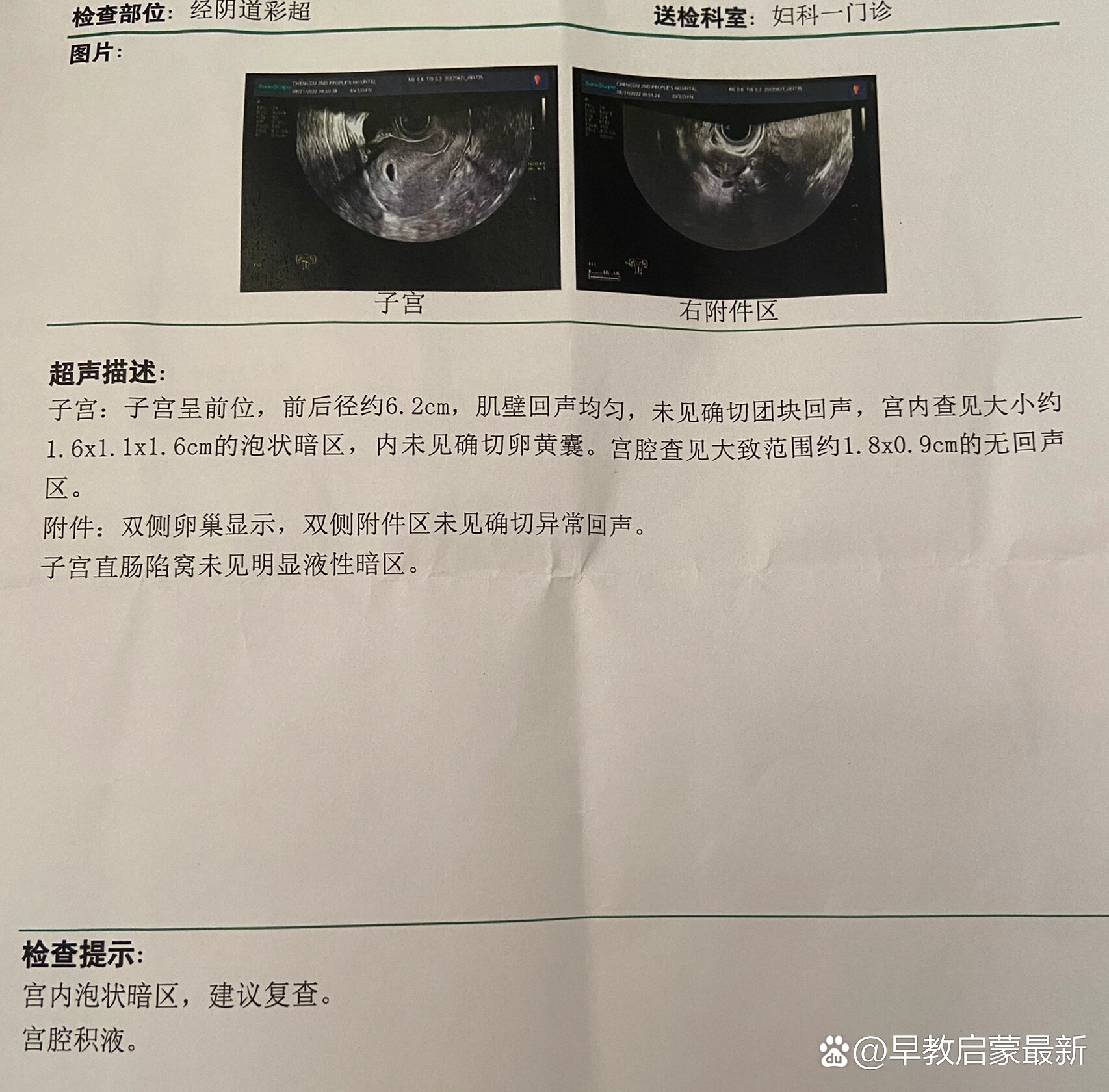 去医院做了阴超检查