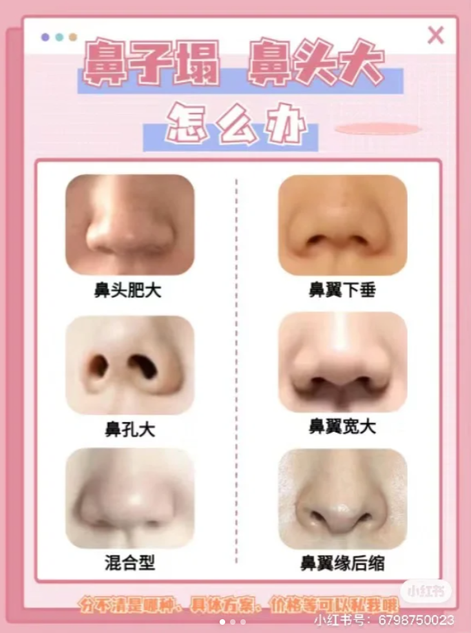  ①鼻头肥大表现:鼻头软组织肥厚,摸上去肉肉的,厚厚的