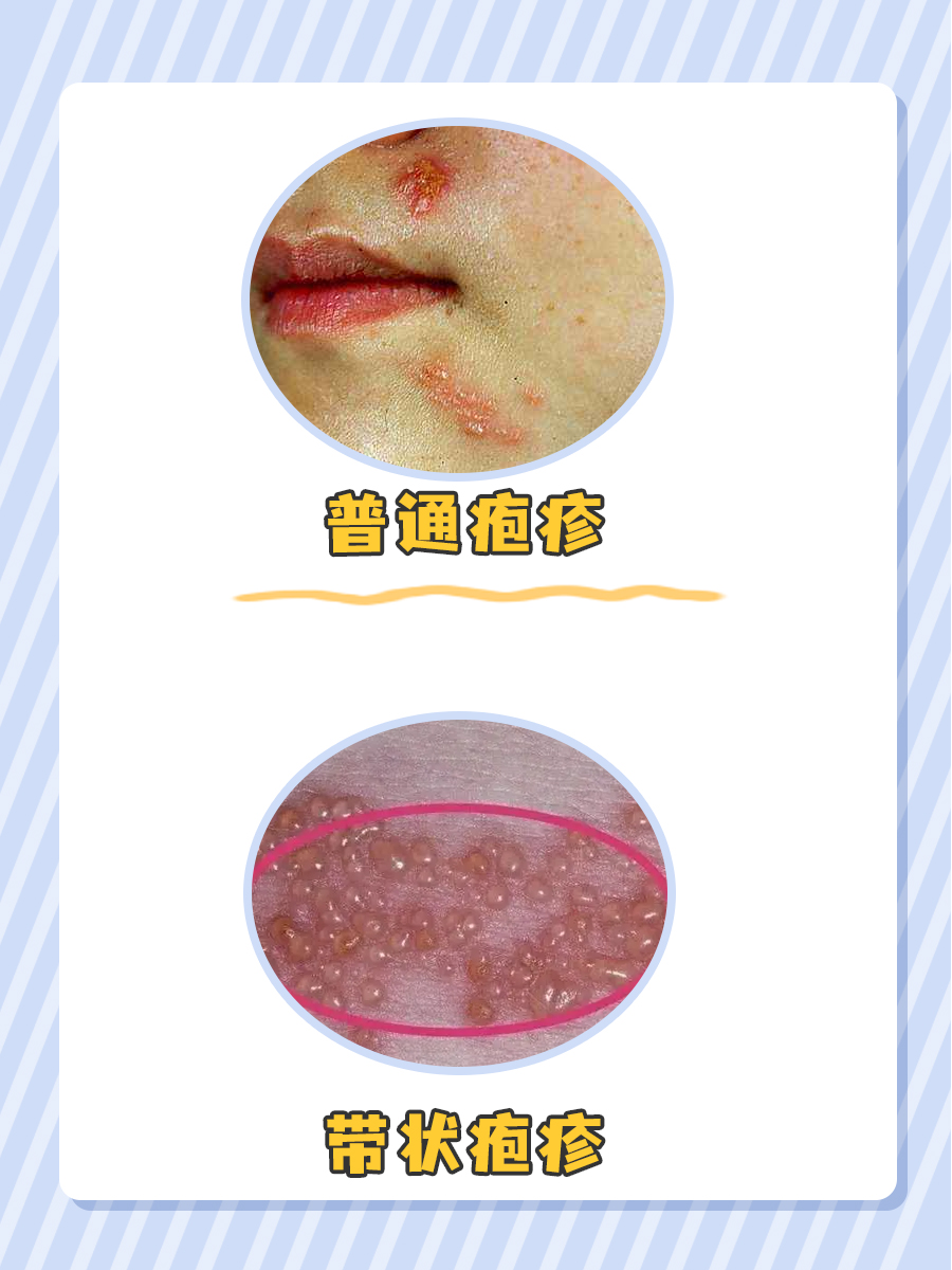 读完这篇,你就会了解带状疱疹和疱疹的区别