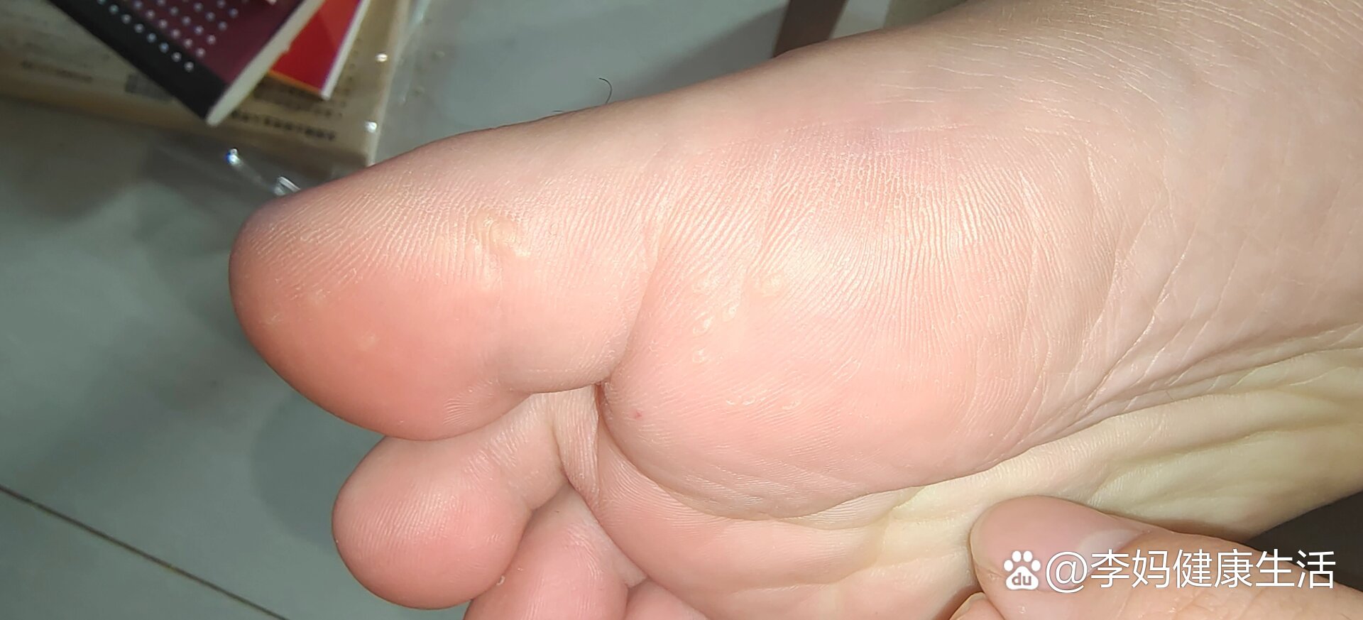脚底长了许多硬硬的小白凸起