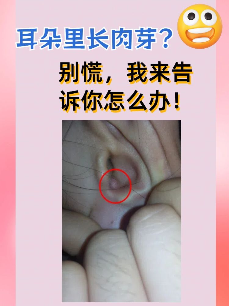 耳朵里长肉芽?别慌,我来告诉你怎么办!