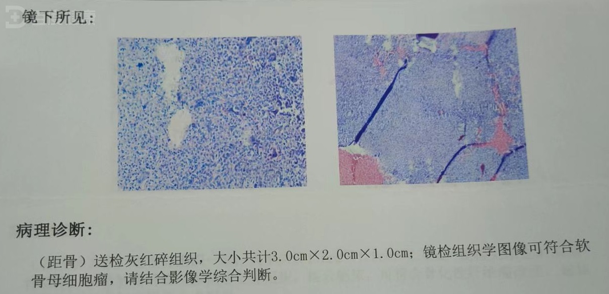 软骨母细胞瘤的原因是什么?