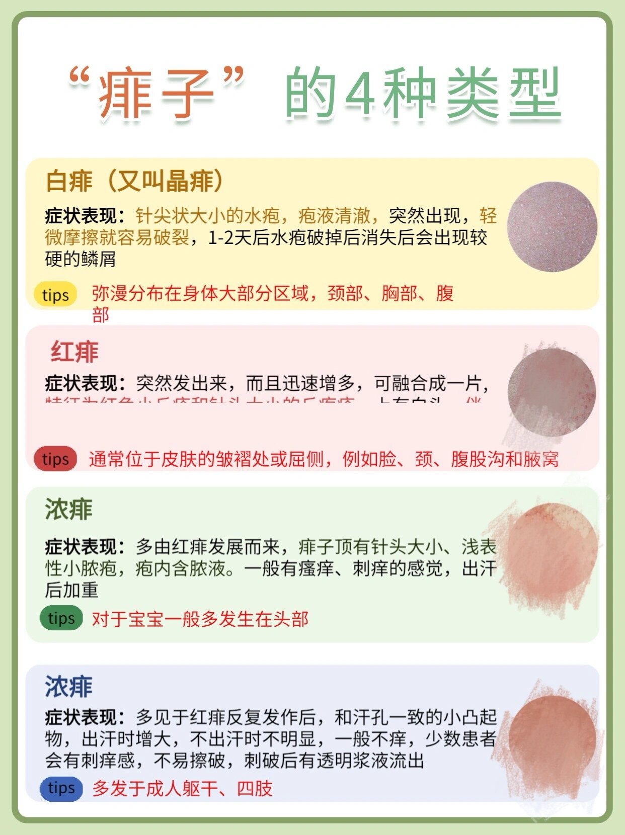 91夏天宝宝常见的4种痱子7515如何区分护理