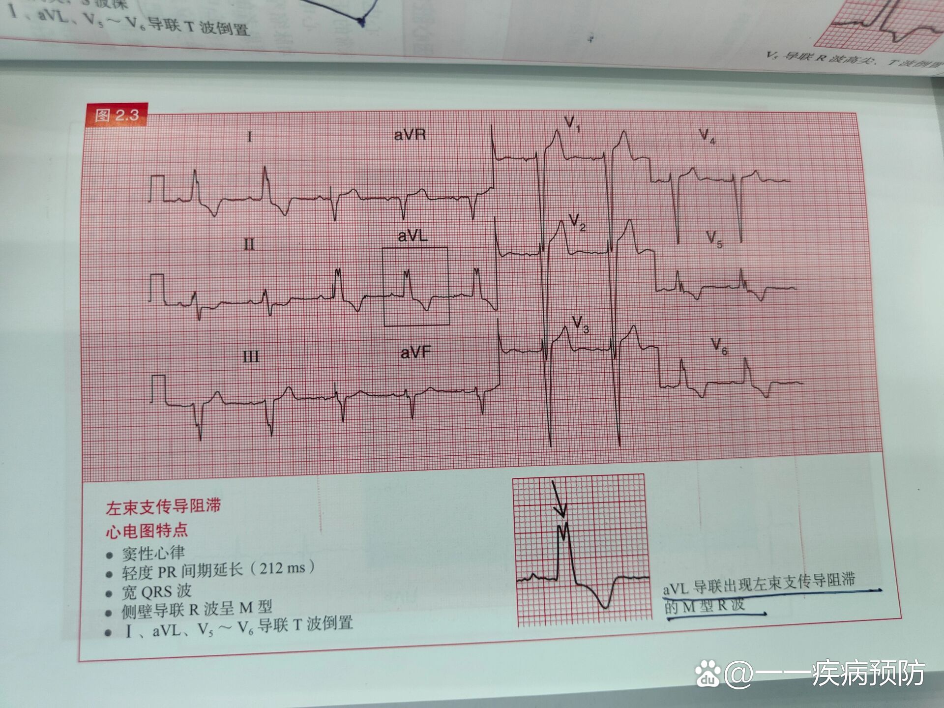 左心房肥大的心电图图片