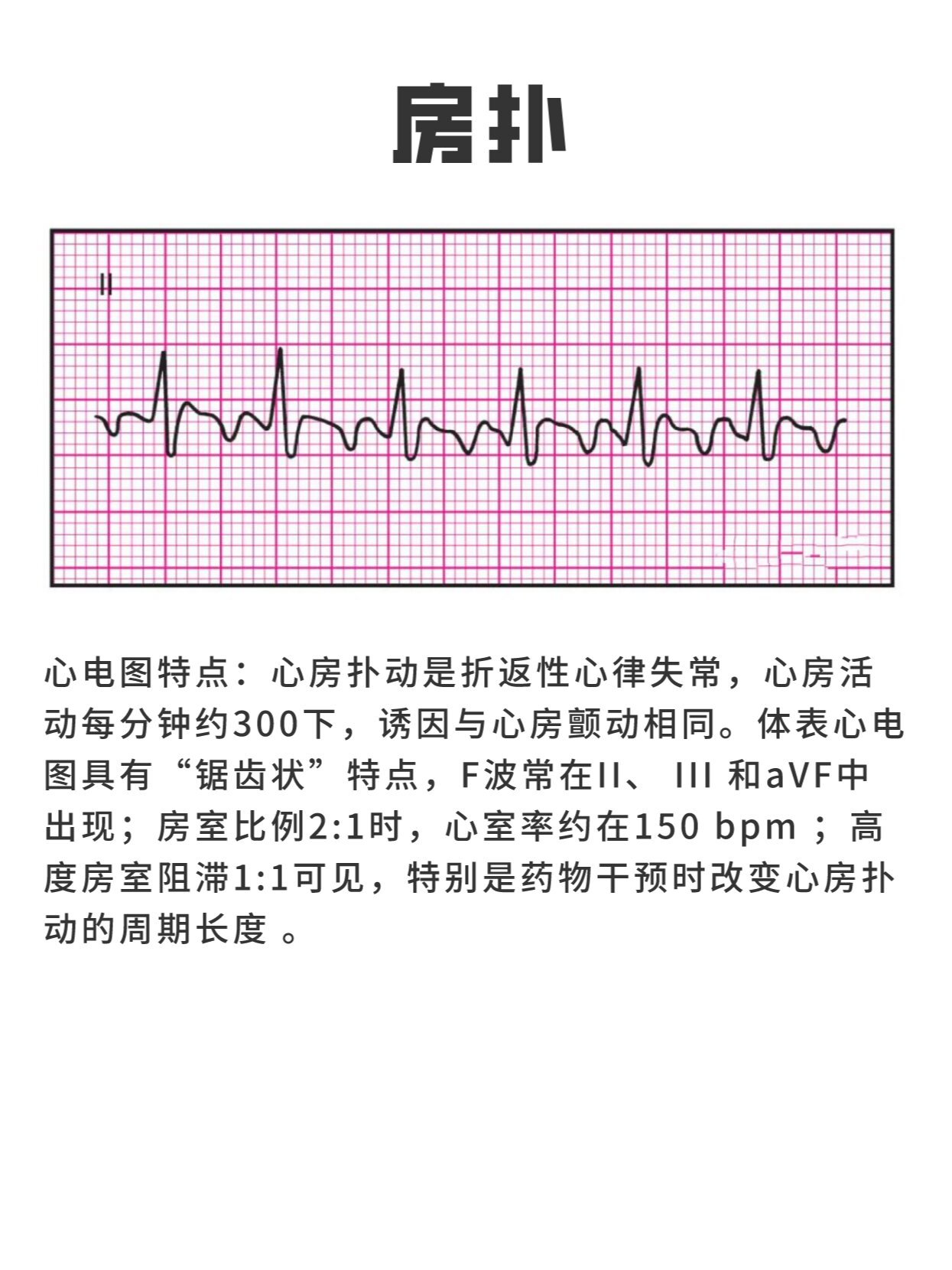 十三种异常心电图图片