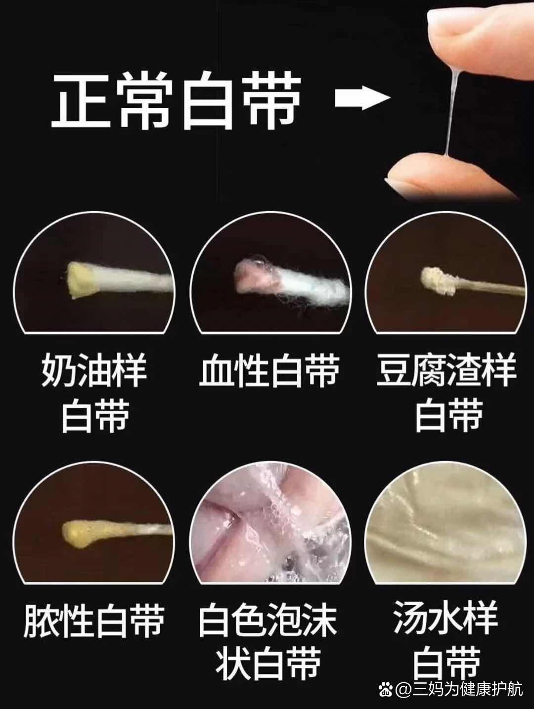 白带豆腐渣会自愈吗图片