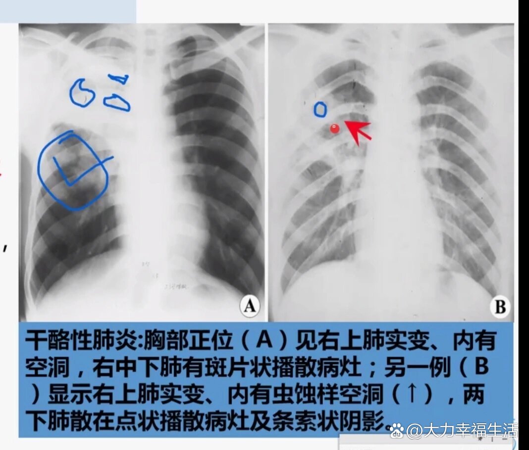 肺结核x线图