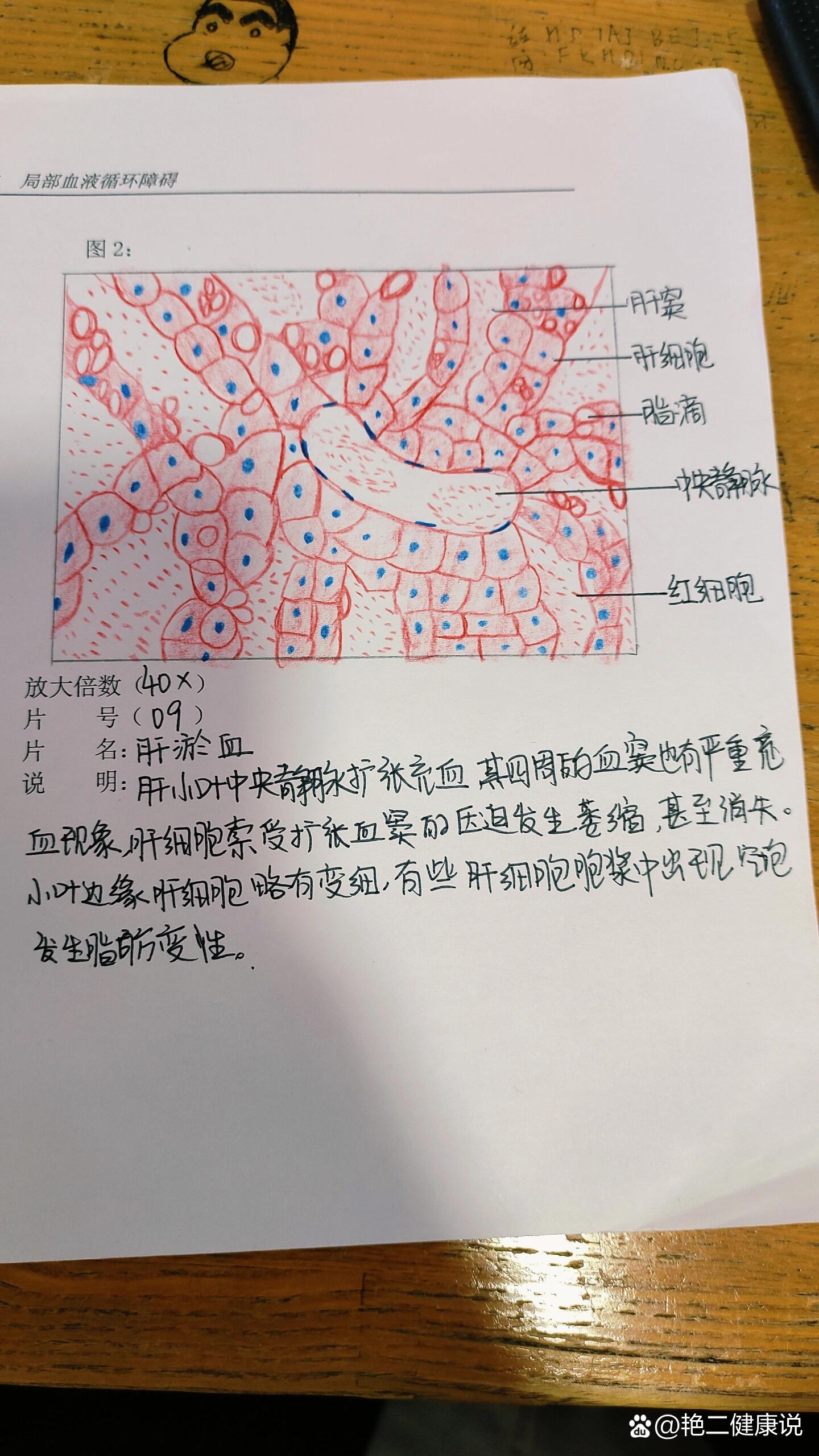 肝淤血大体手绘图图片