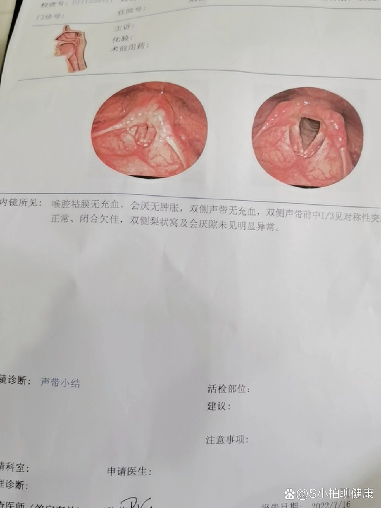 杓会厌皱襞水肿图片