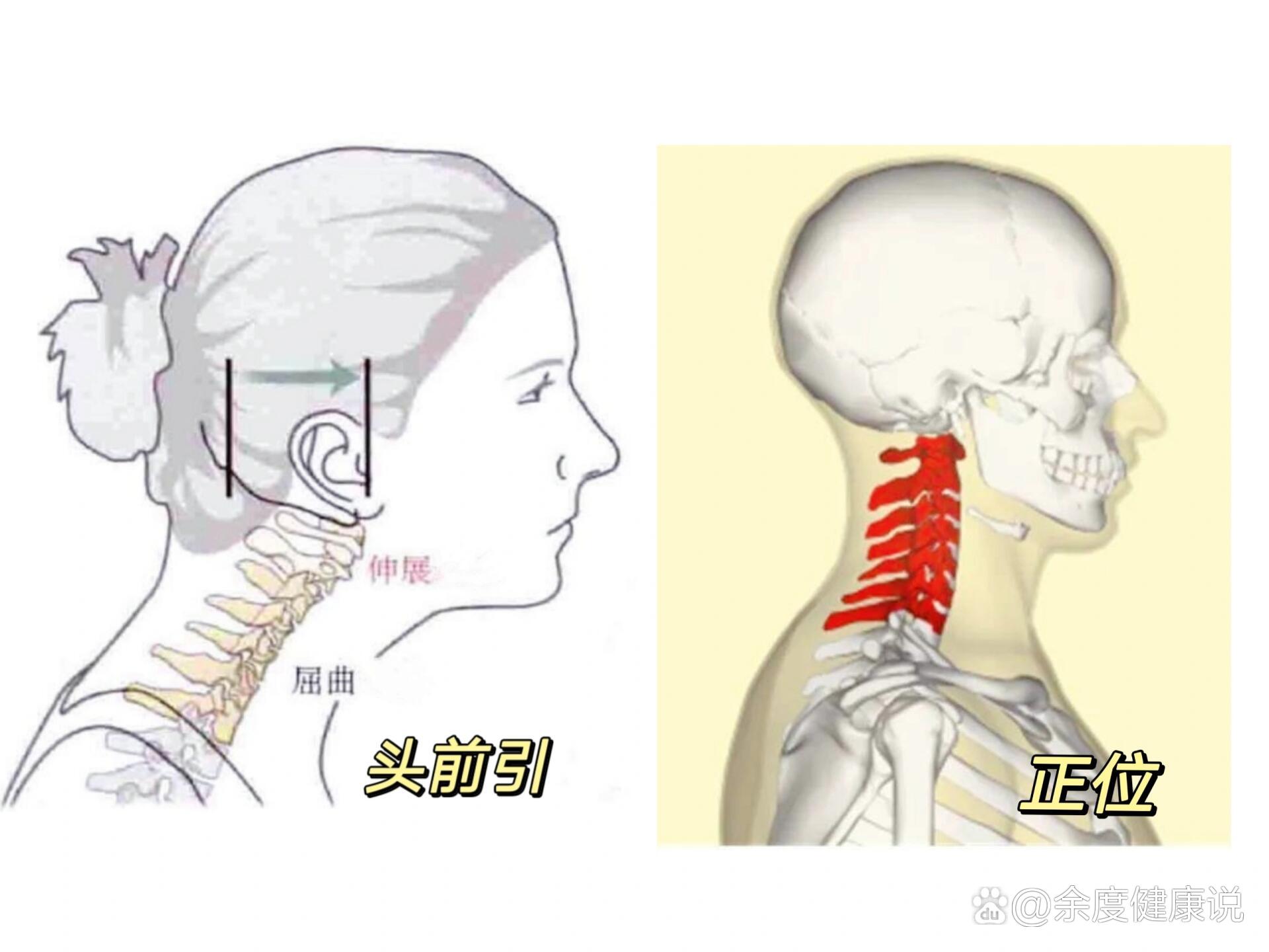 颈强直检查方法图片