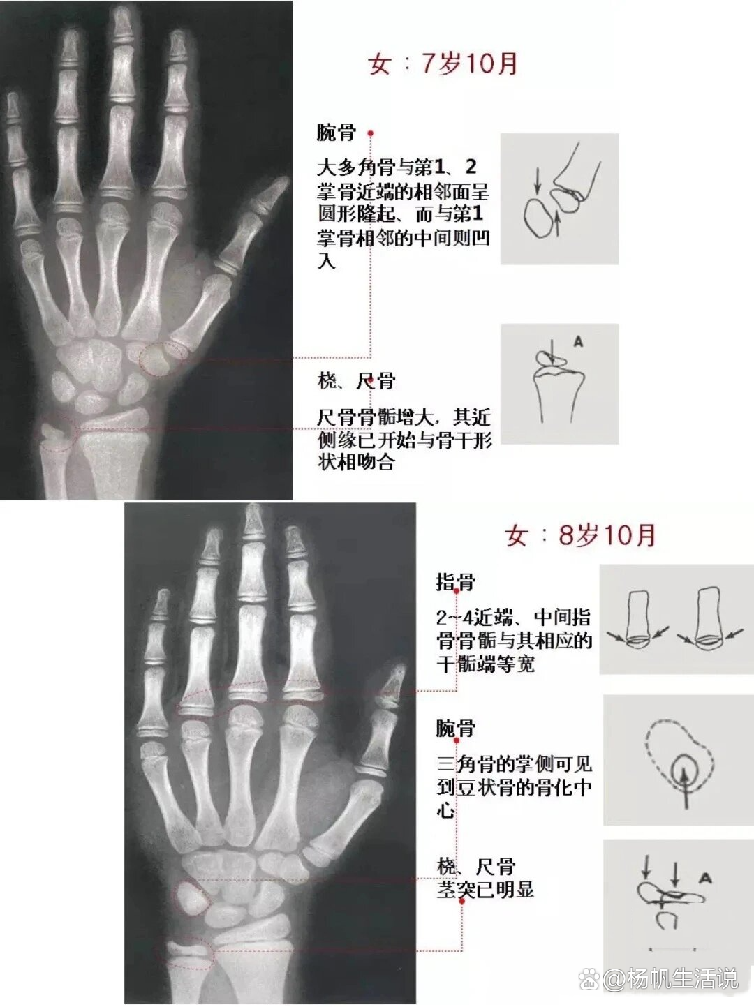 女童骨龄图谱