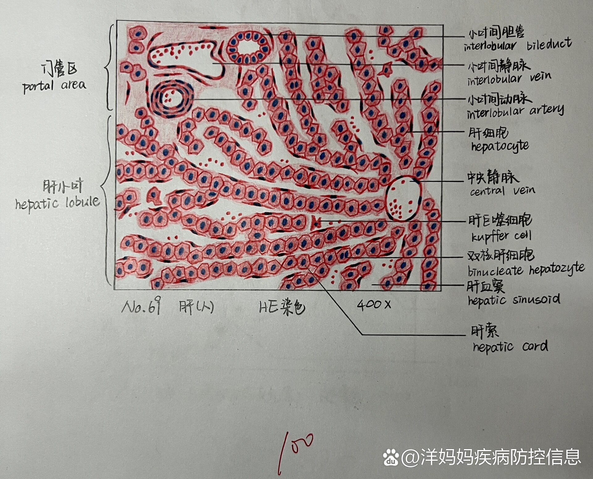 肝硬化假小叶手绘图图片