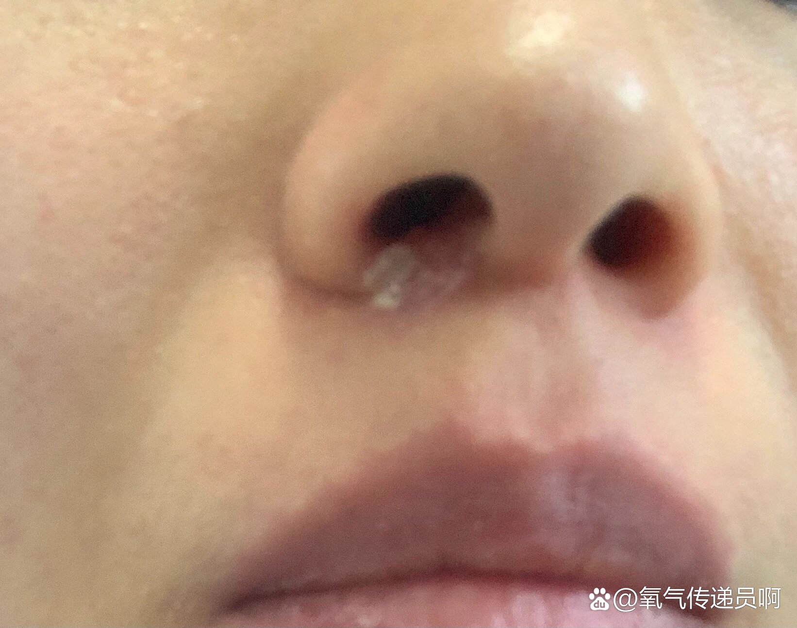 鼻子上火起水泡的克星,终于找到了