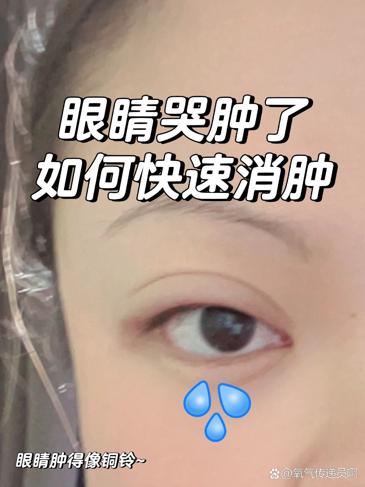 眼睛浮肿什么原因图片