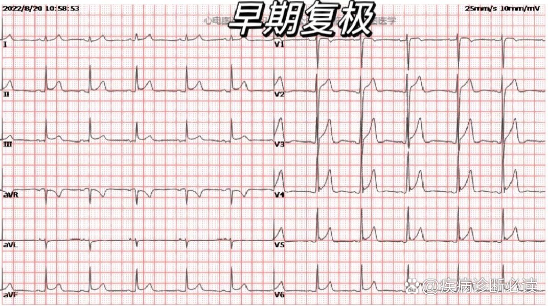早期复极心电图图片