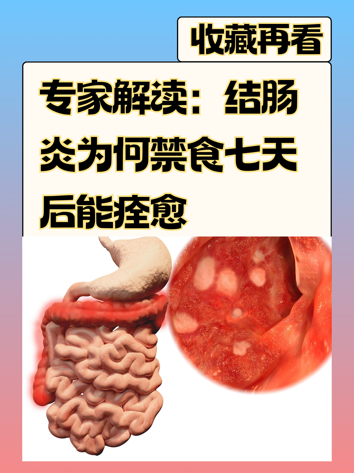 专家解读:结肠炎为何禁食七天后能痊愈