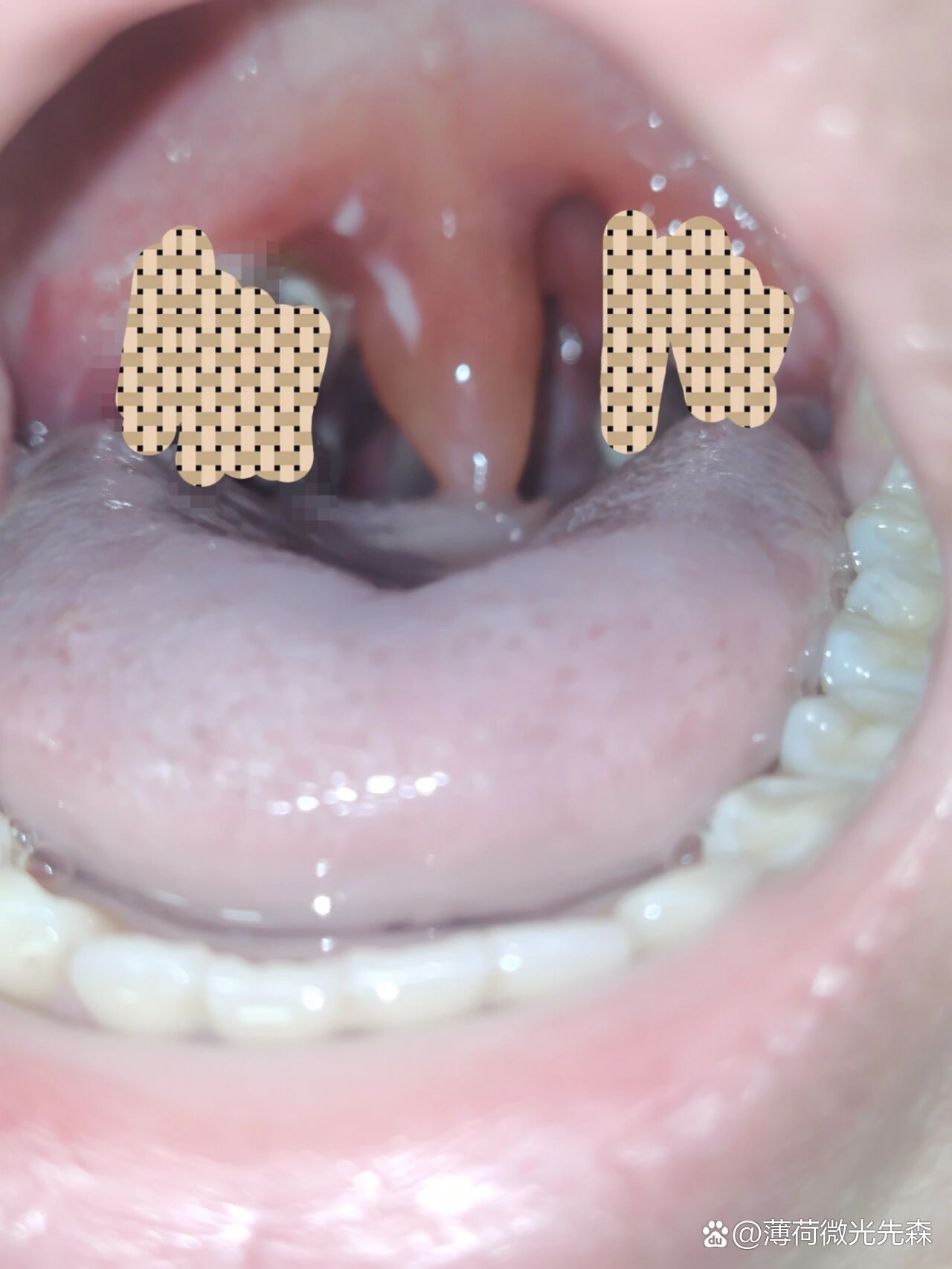 扁桃体手术,小舌头肿到睡觉就憋醒