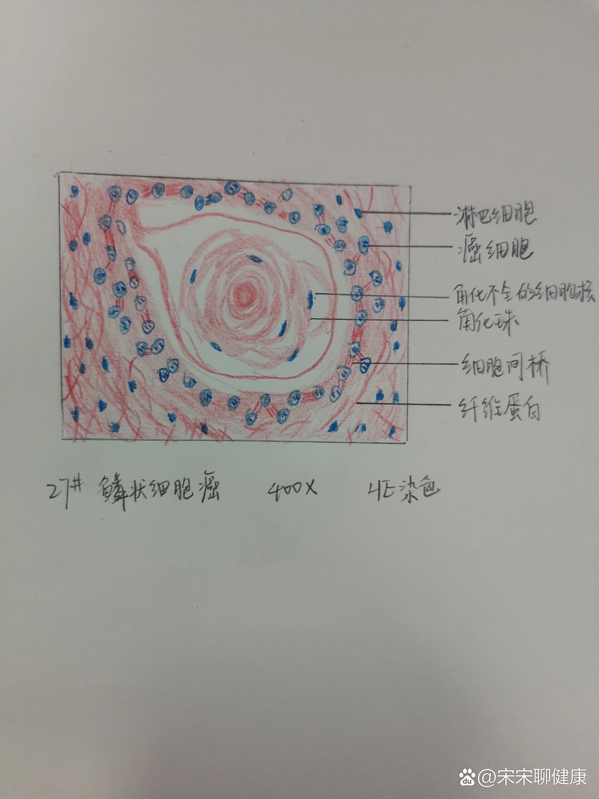 鳞状细胞癌