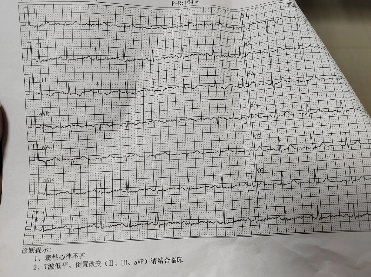 事业单位预体检:窦性心律不齐