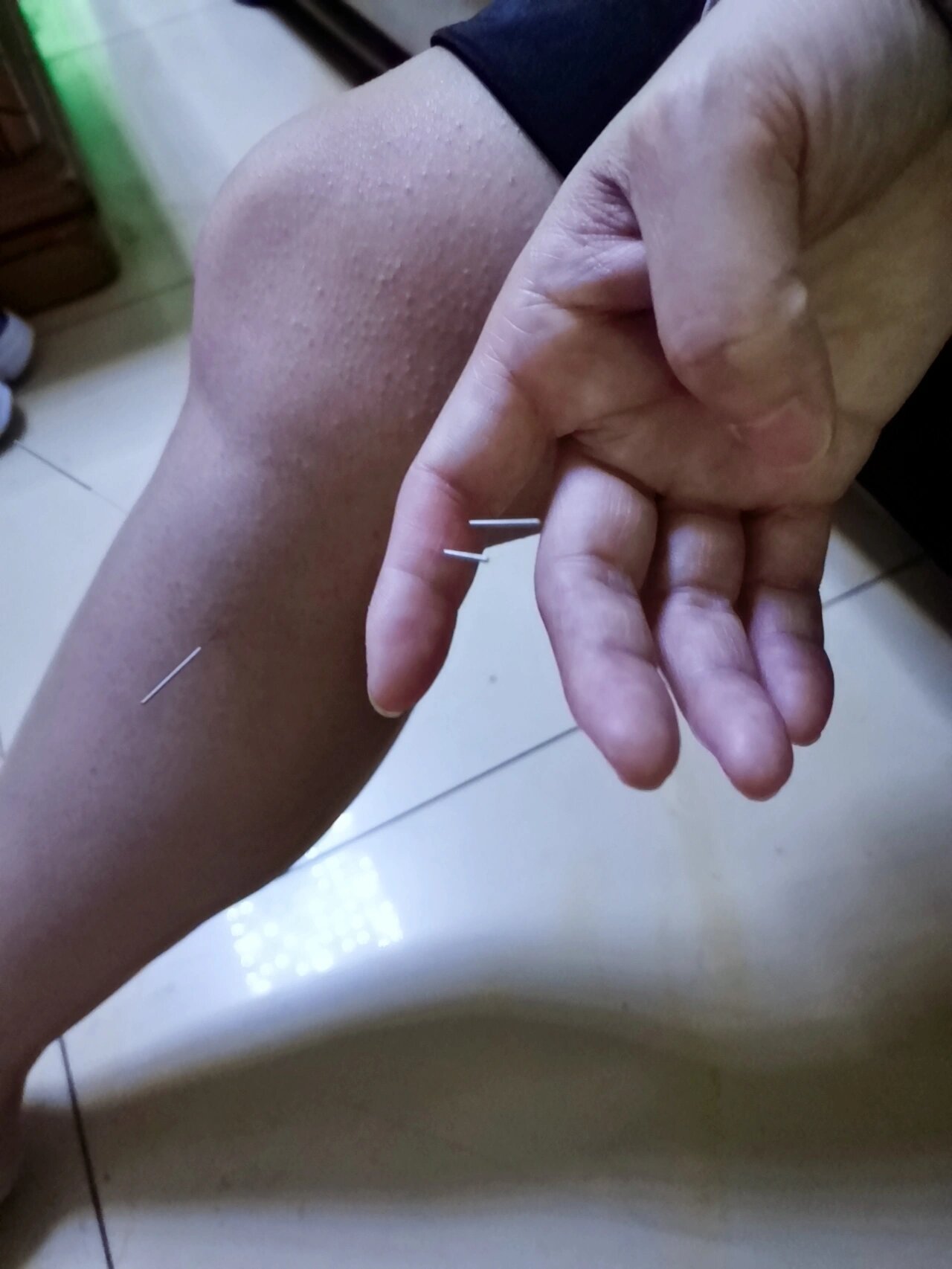 针灸治疗小便尿不出