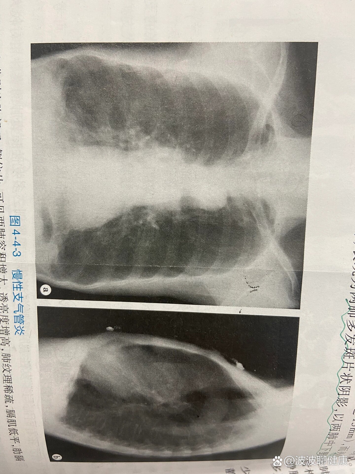 慢性支气管炎x线表现图片