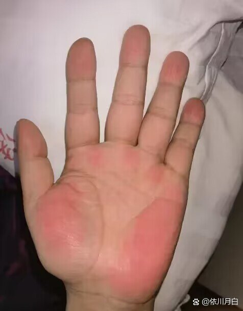 双手手掌两侧的大,小鱼际和指尖掌面会出现片状发红区域或粉红色斑点