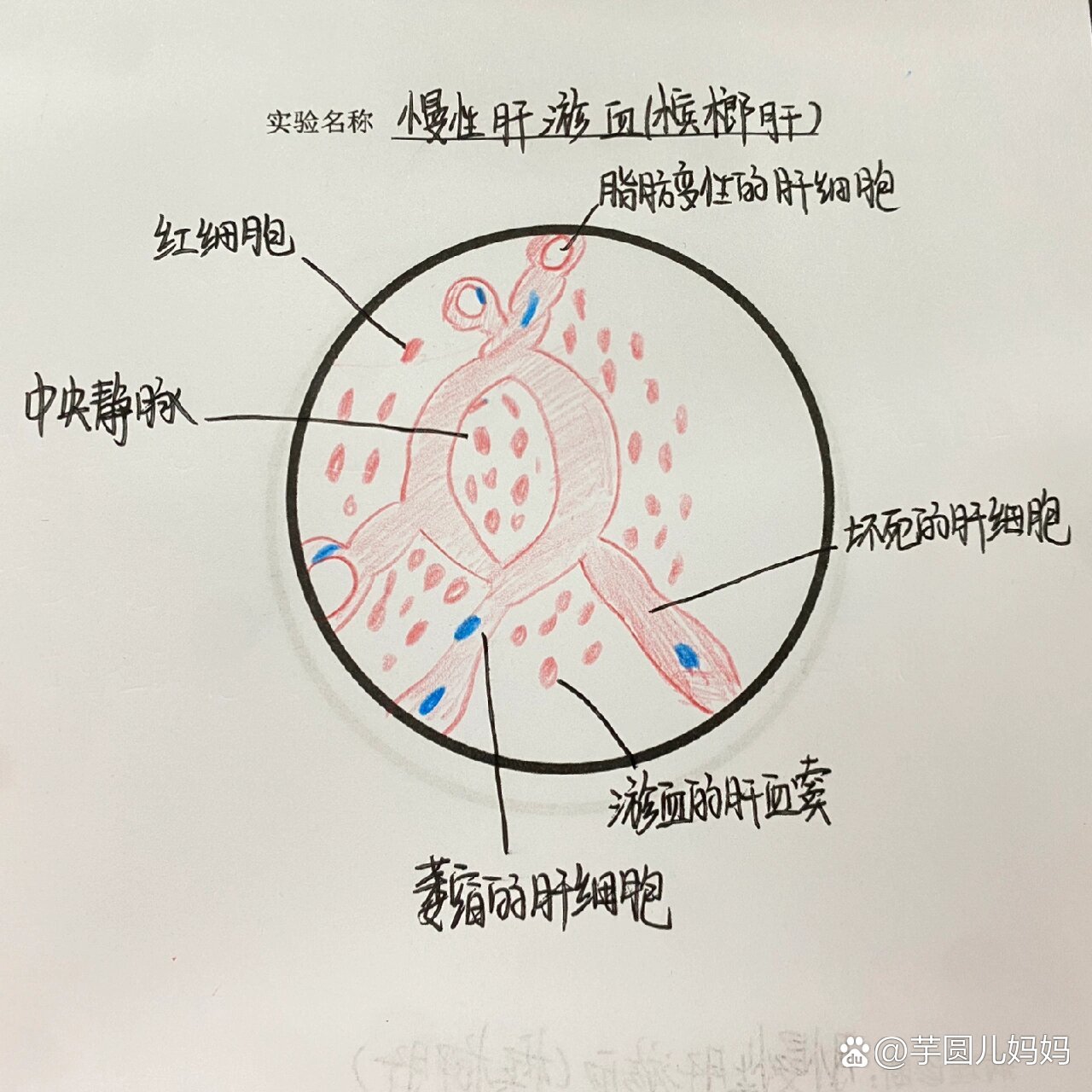 肝淤血图片带标注图片