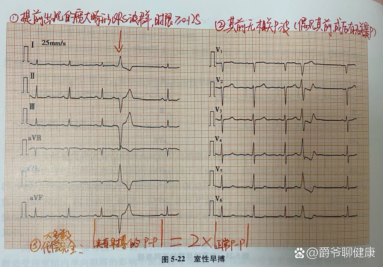 室性早搏心电图特点图片