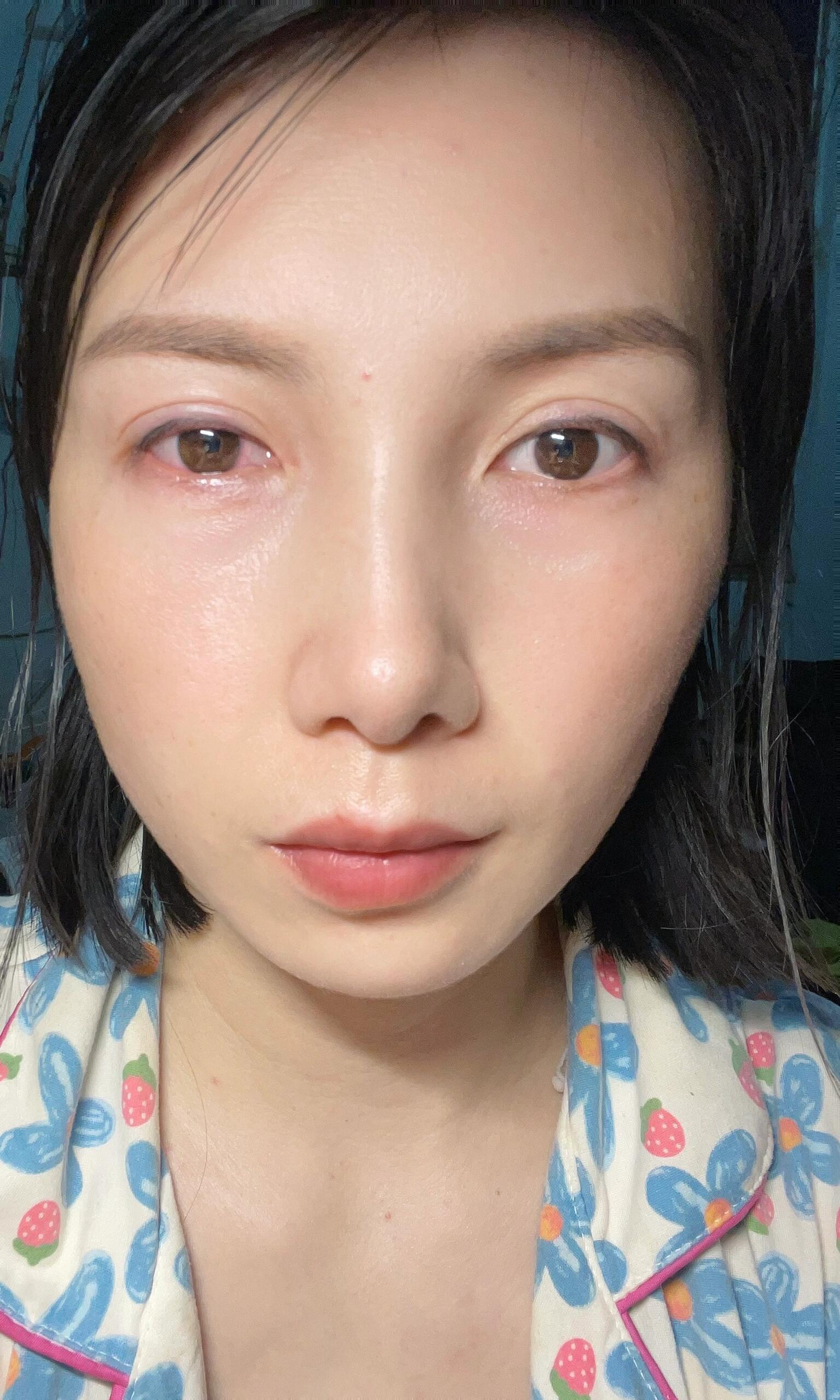 闺女的小手指,把我的眼角膜戳掉了一块01