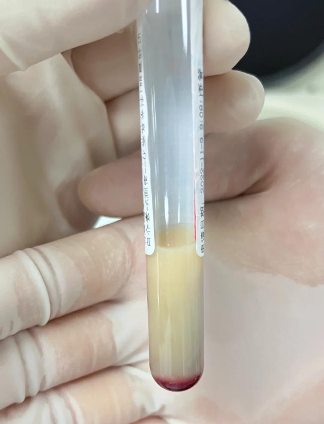 脂血标本处理：从超速离心到公式计算