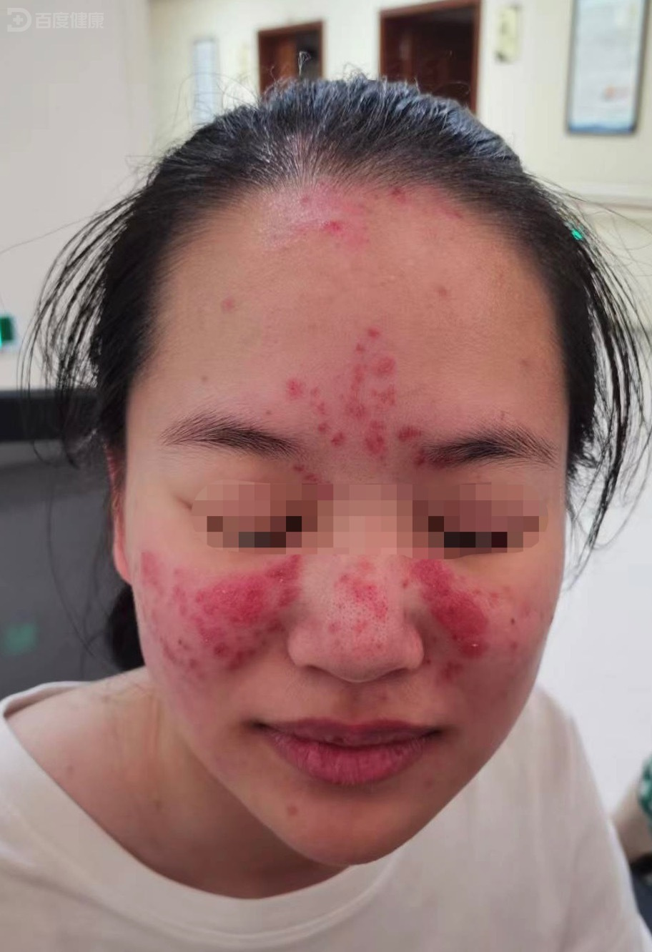 狼疮性肾炎花季少女多,是什么原因导致呢?