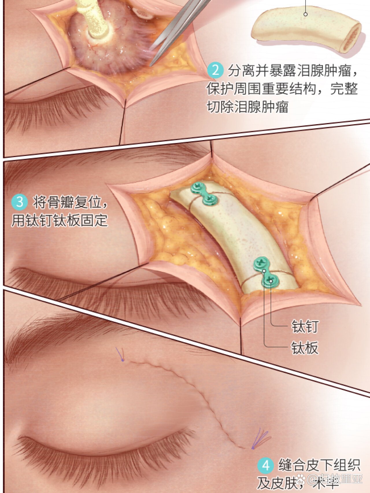 泪腺肿瘤切除术示意图04