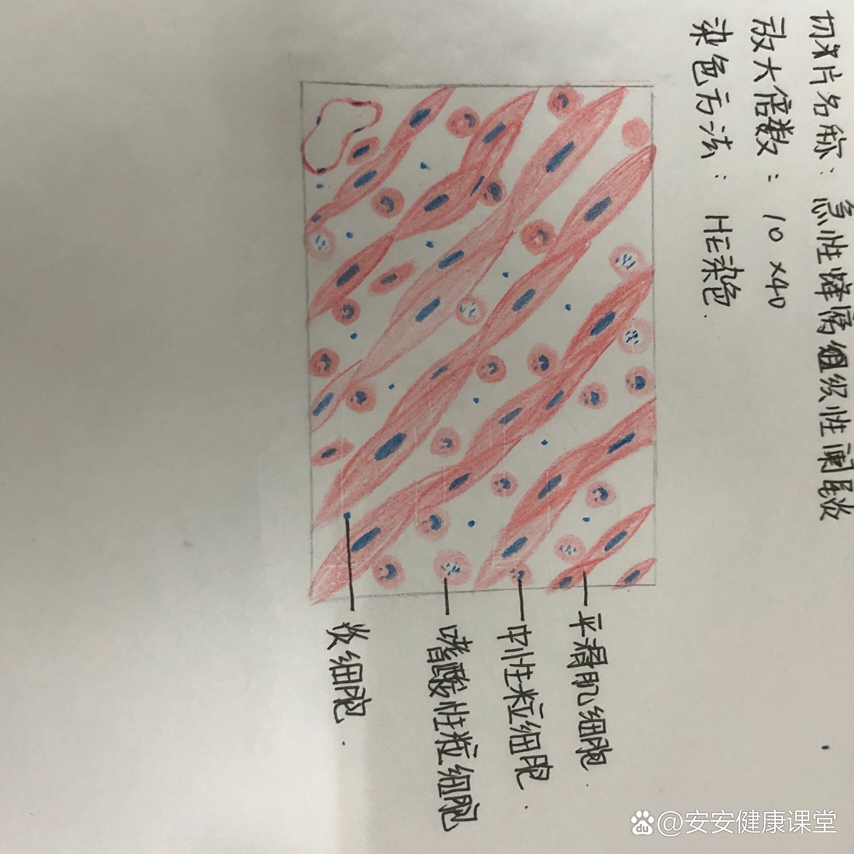 病理实验阑尾炎手绘图图片