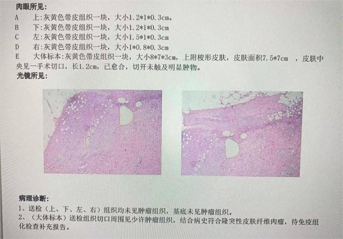 隆突性纤维肉瘤图片